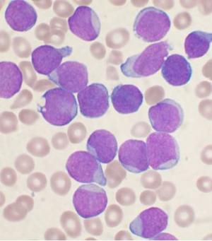 leukemia