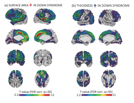 s_Cortex is Thicker in Brains with Down Syndrome